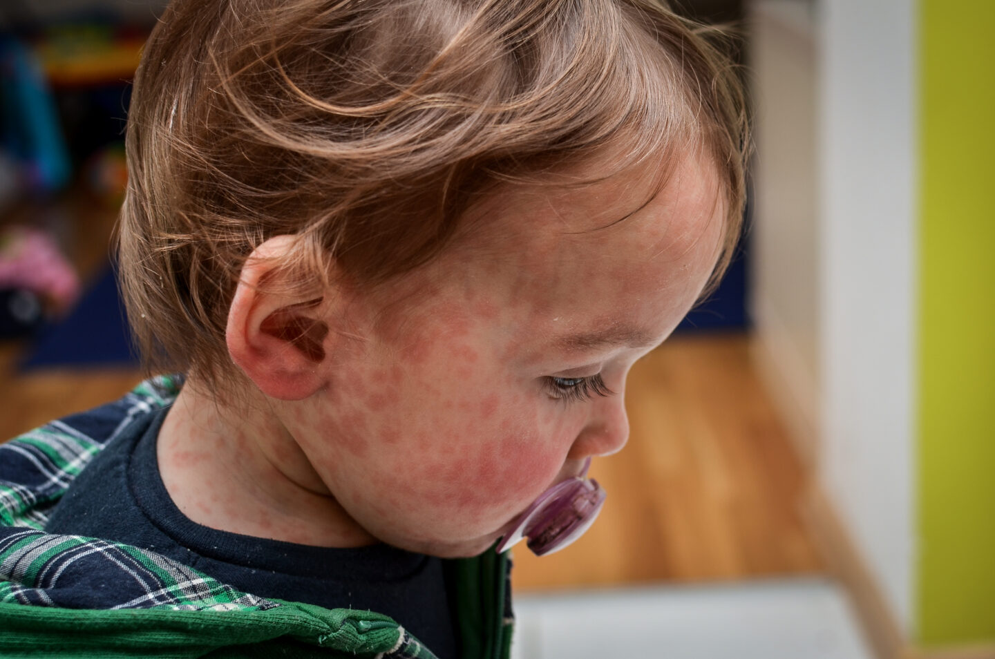 Child dies of horrifying measles complication in Los Angeles - Ars Technica