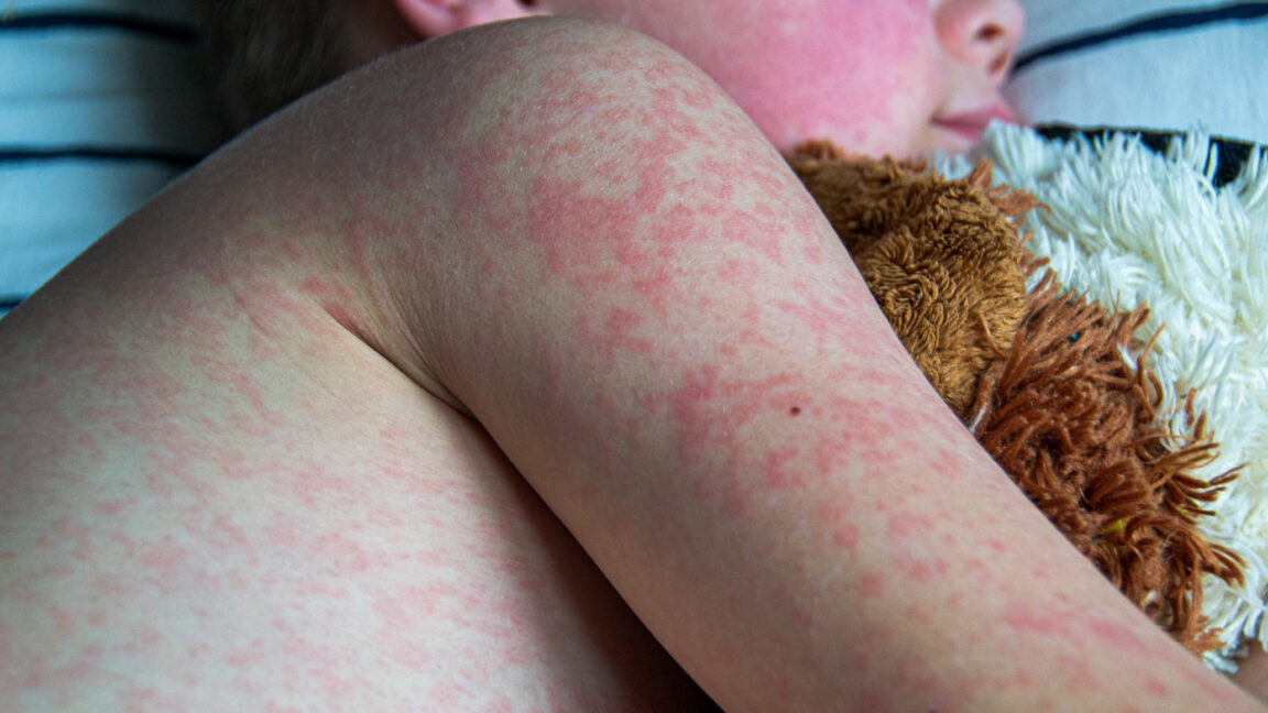 Unvaccinated school-aged child dies of measles in Texas amid growing outbreak