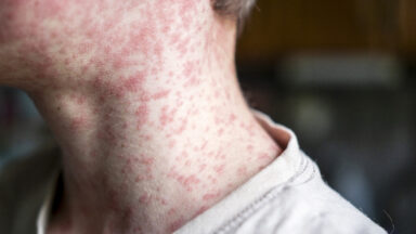 Urgent Health Alert: Measles Outbreak Triggers Quarantine for Over 150 Children in South Carolina