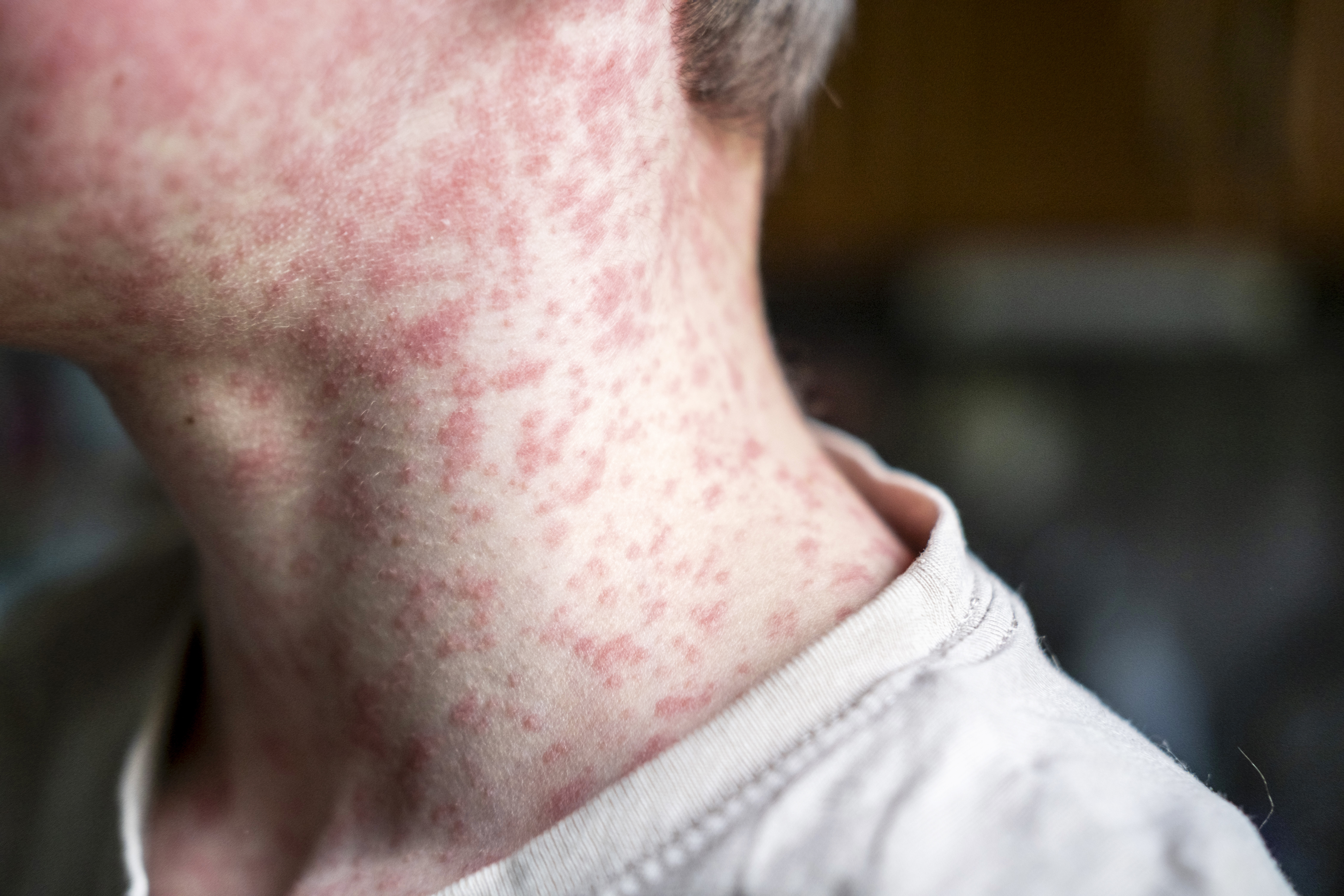 18-year-old dies of measles in PA from severe neurological complication