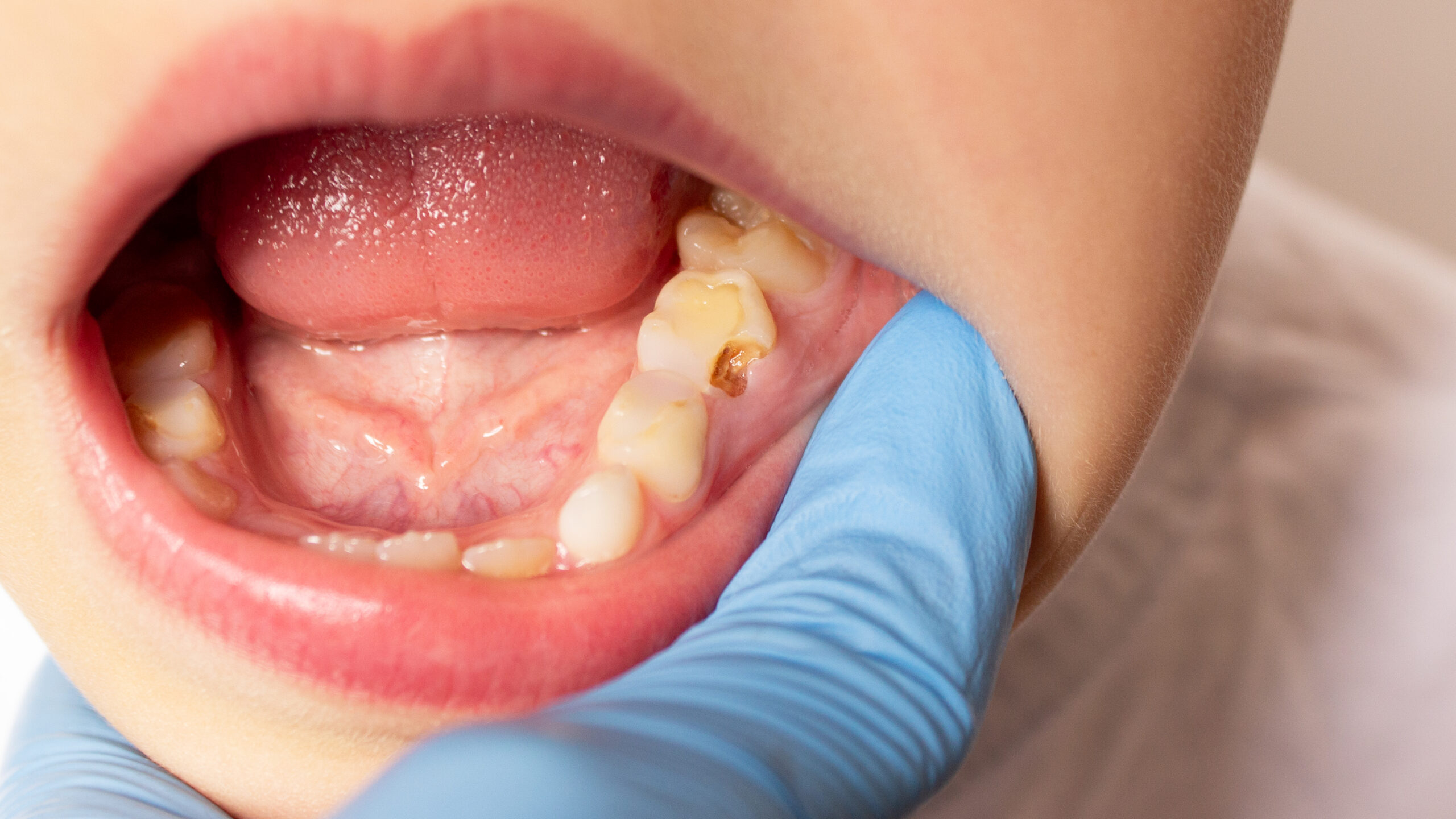 RFK Jr.’s fluoride ban would ruin 25 million kids’ teeth, cost .8 billion
