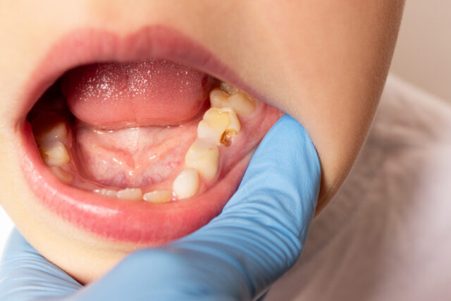 RFK Jr.’s fluoride ban would ruin 25 million kids’ teeth, cost $9.8 billion