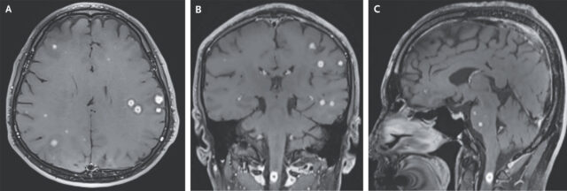 When doctors describe your brain scan as a “starry sky,” it’s not good 2 nejmicm2415077 f1