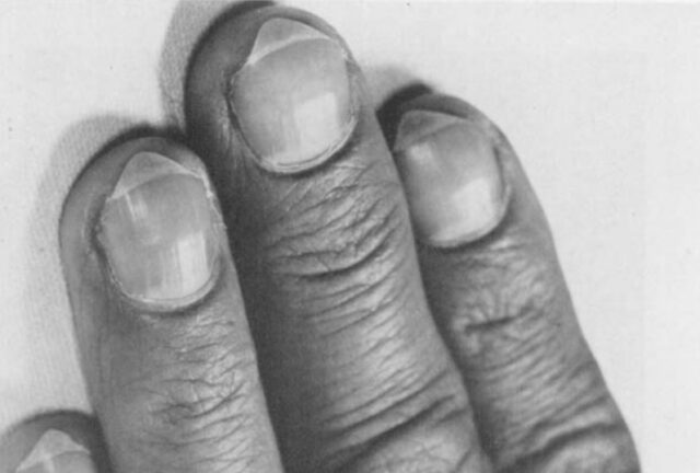 closeup of a hand with clubbed fingernails