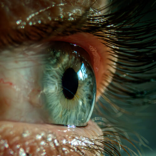 Bad sleep made woman's eyelids so floppy they flipped inside out, got stuck