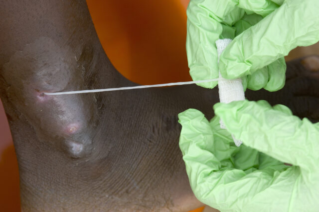 Guinea worm on track to be 2nd eradicated human disease; only 10 cases in 2025