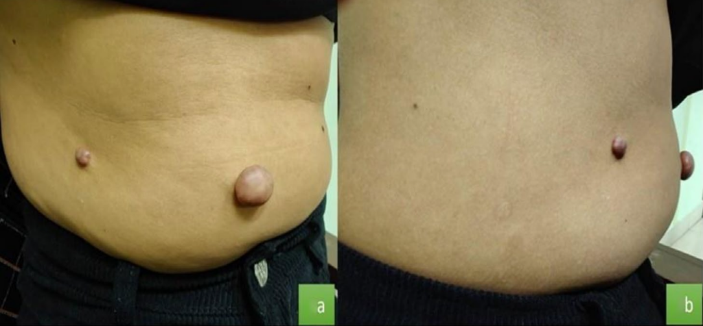 Masses on her abdomen and side