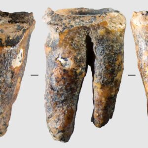 photo of a molar from five sides, showing a large drilled hole in the chewing surface