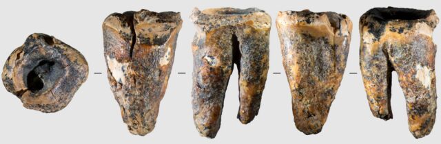 photo of a molar from five sides, showing a large drilled hole in the chewing surface
