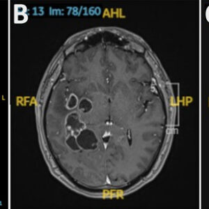 Doctors suspected man had brain cancer. He actually had worms.