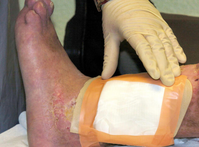 Second carcass-eating fly species cleared by FDA for maggot wound therapy