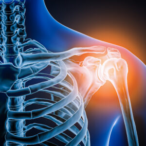 Doctors took a look at man’s painful shoulder—they found the joint was missing
