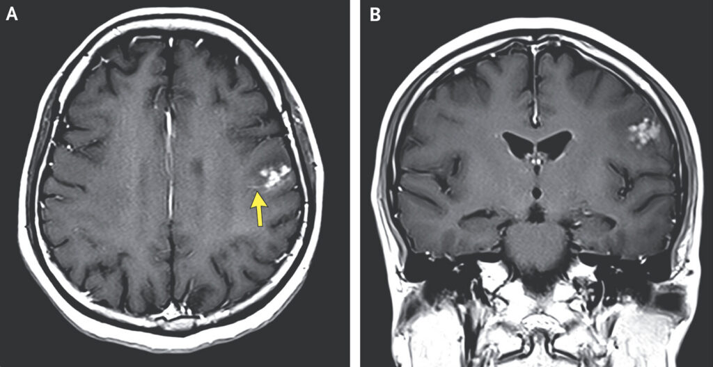 Woman's brain worm infection confirmed after eggs grow tails in lab test