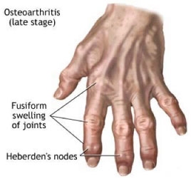 A new scaffold to treat arthritis | Ars Technica