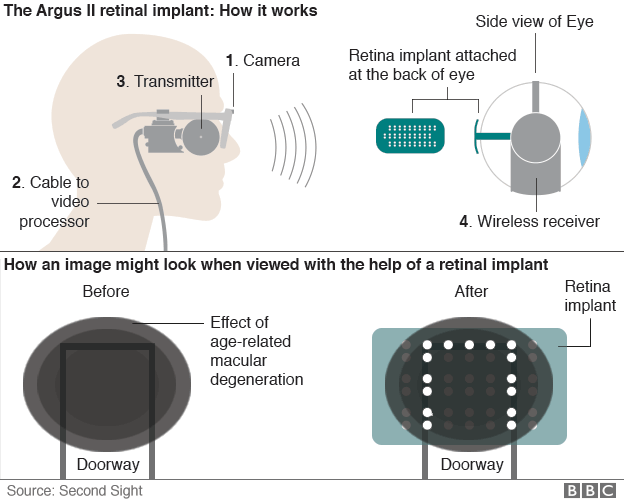 How the Argus II retinal prosthesis works